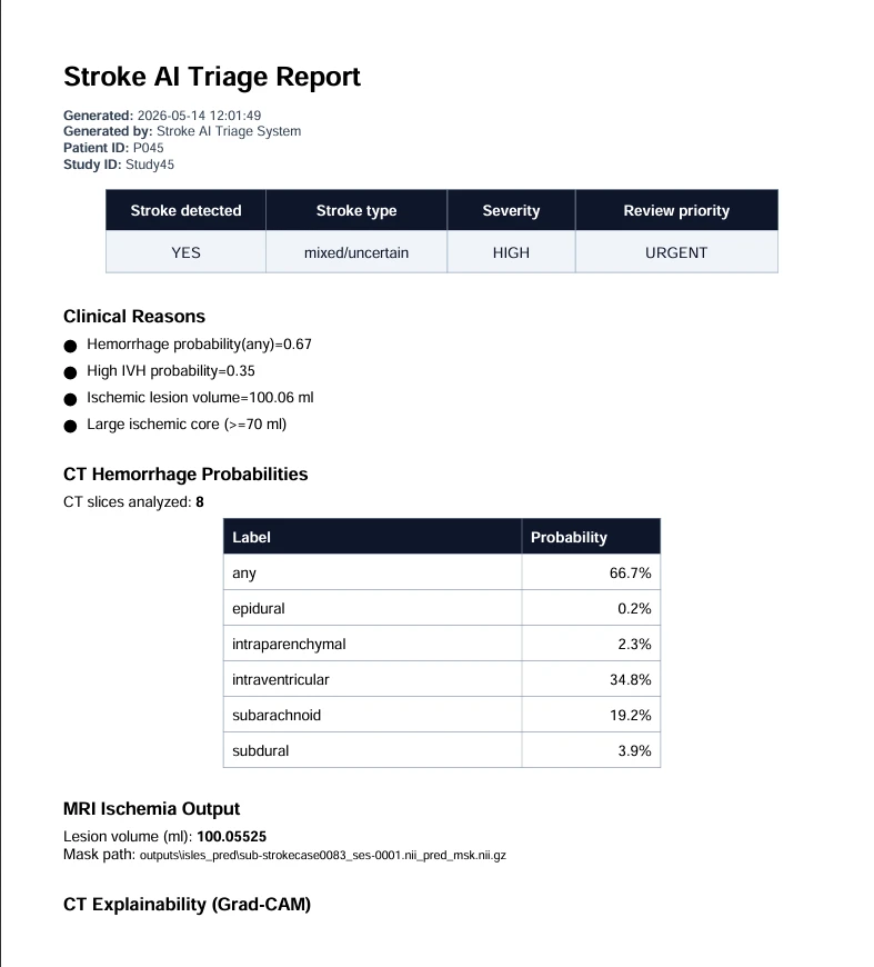 The generated Stroke AI Triage Report: stroke detected YES, type mixed or uncertain, severity HIGH, review priority URGENT, clinical reasons, a table of CT haemorrhage probabilities and the MRI ischaemia output.